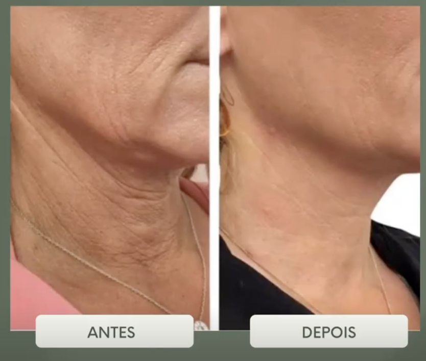 Antes e depois de bioestimulador — Pescoço e mandíbula — firmeza