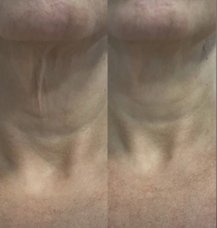 Antes e depois de bioestimulador — Pescoço — textura