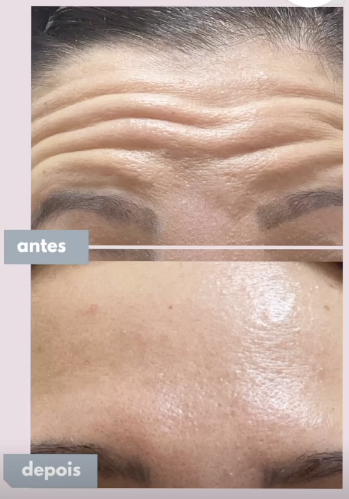 Antes e depois de aplicação de toxina botulínica na testa