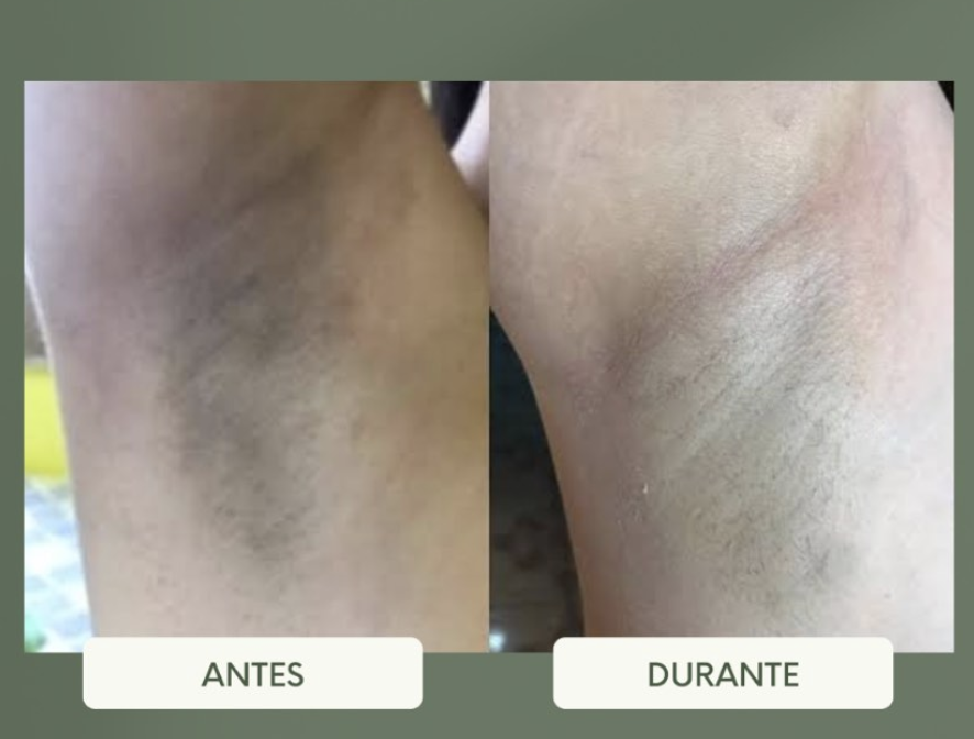 Antes e durante o tratamento de depilação a laser na axila