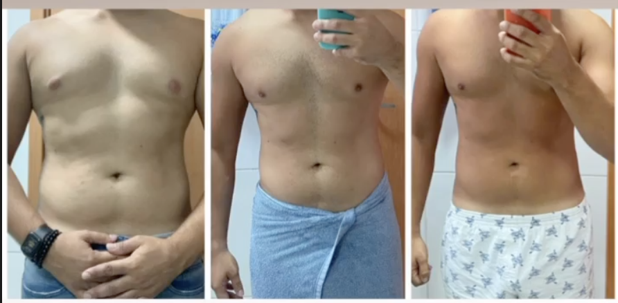 Antes, durante e depois de paciente do programa de emagrecimento