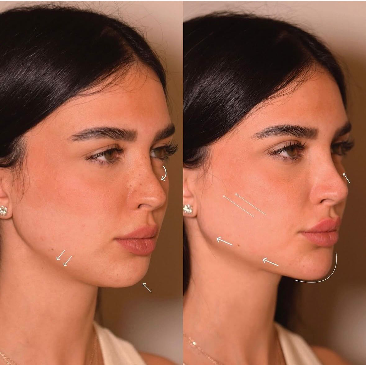 Harmonização / Full Face