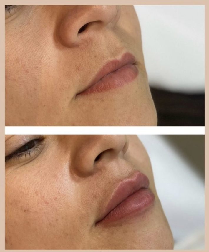 Antes e depois de preenchimento labial