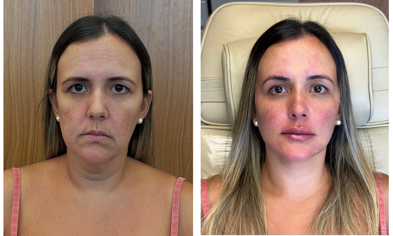 Rejuvenescimento Facial