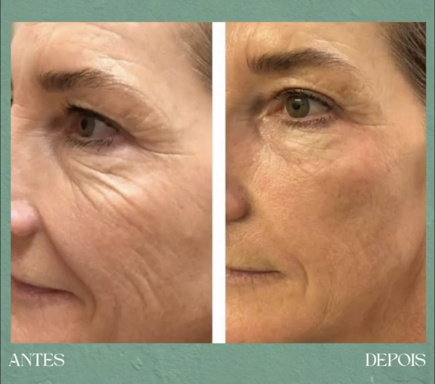 Antes e depois de tratamento Ultraformer microfocado